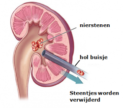 percutane_niersteenverbrijzeling