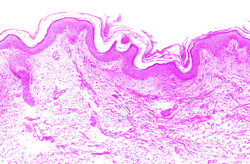 Mastocytose en hereditair angio-oedeem