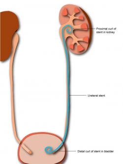 dubbel_j_stent