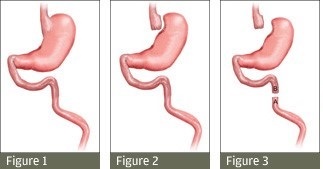 gastric bypass