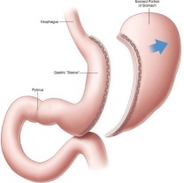 gastric sleeve