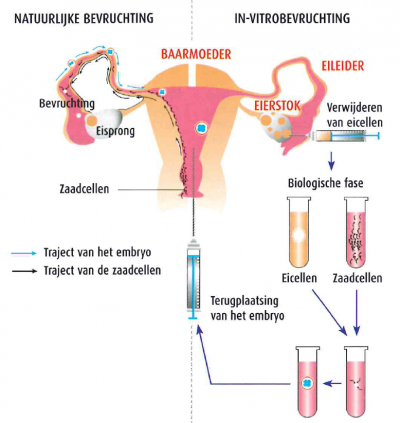 ivf