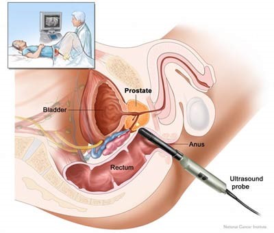 prostaatechografie