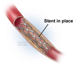 Stentimplantatie