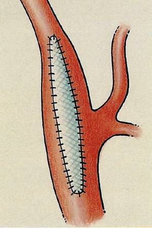 Patchplastiek